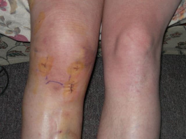 My right knee used to look as good as my left.